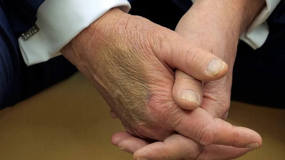 Moretón en la mano de Donald Trum.